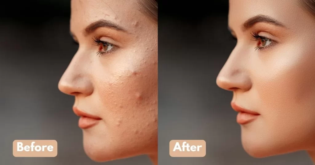 Skin-Boosters-Before-and-After-Results in unity derma